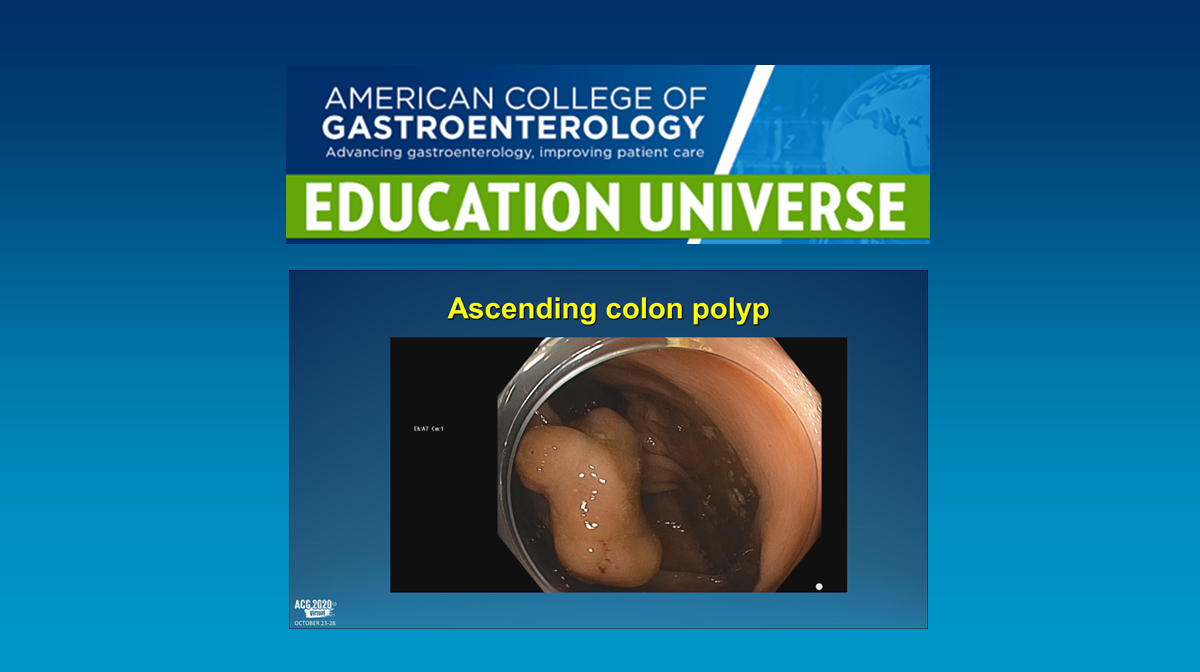 ACG Education Universe: Ascending colon polyp