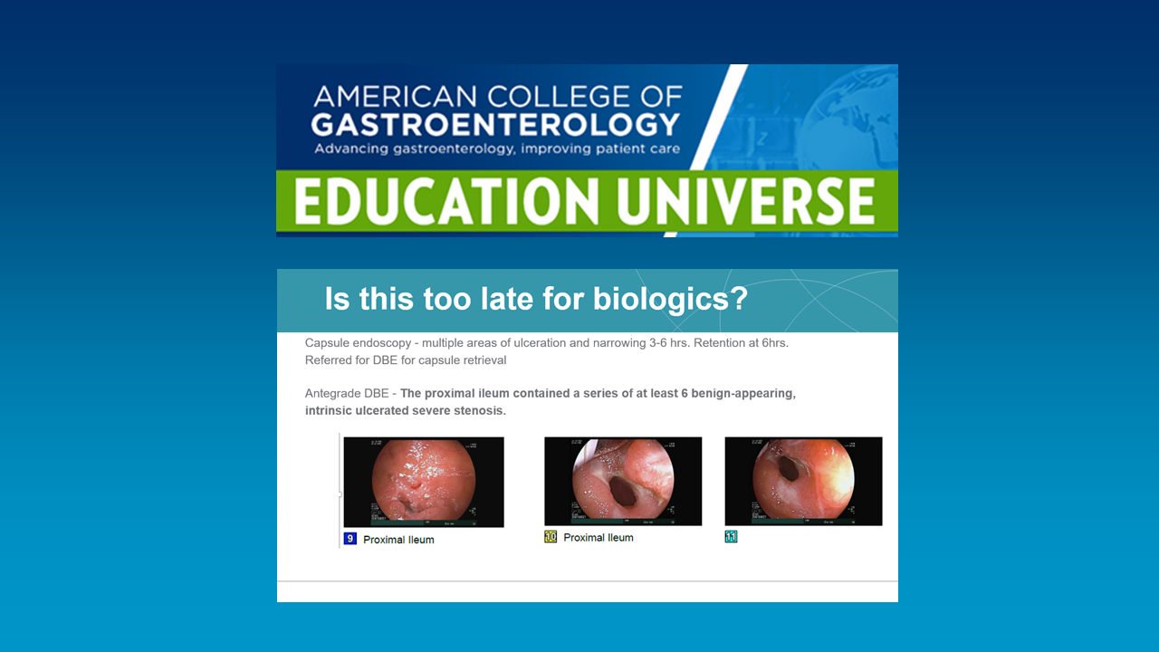ACG Education Universe: Is this too late for biologics