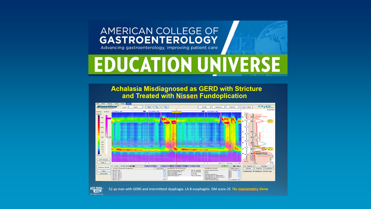 ACG Education Universe: Achalasia Misdiagnosed as GERD with Stricture and Treated with Nissen Fundoplication